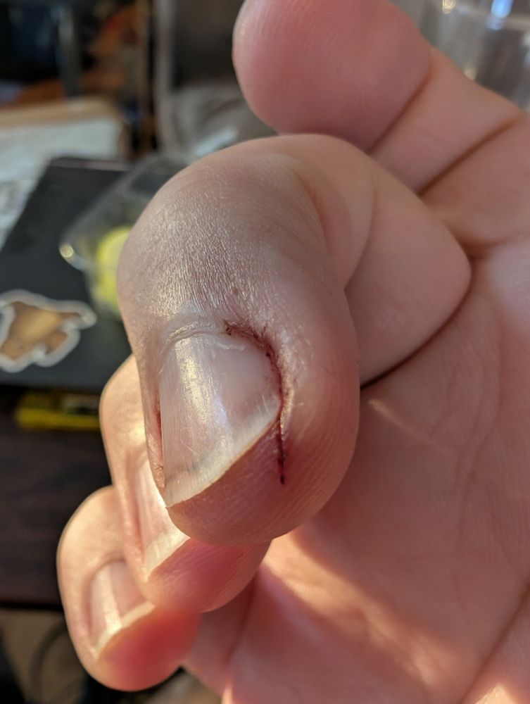 Small cut on a finger.