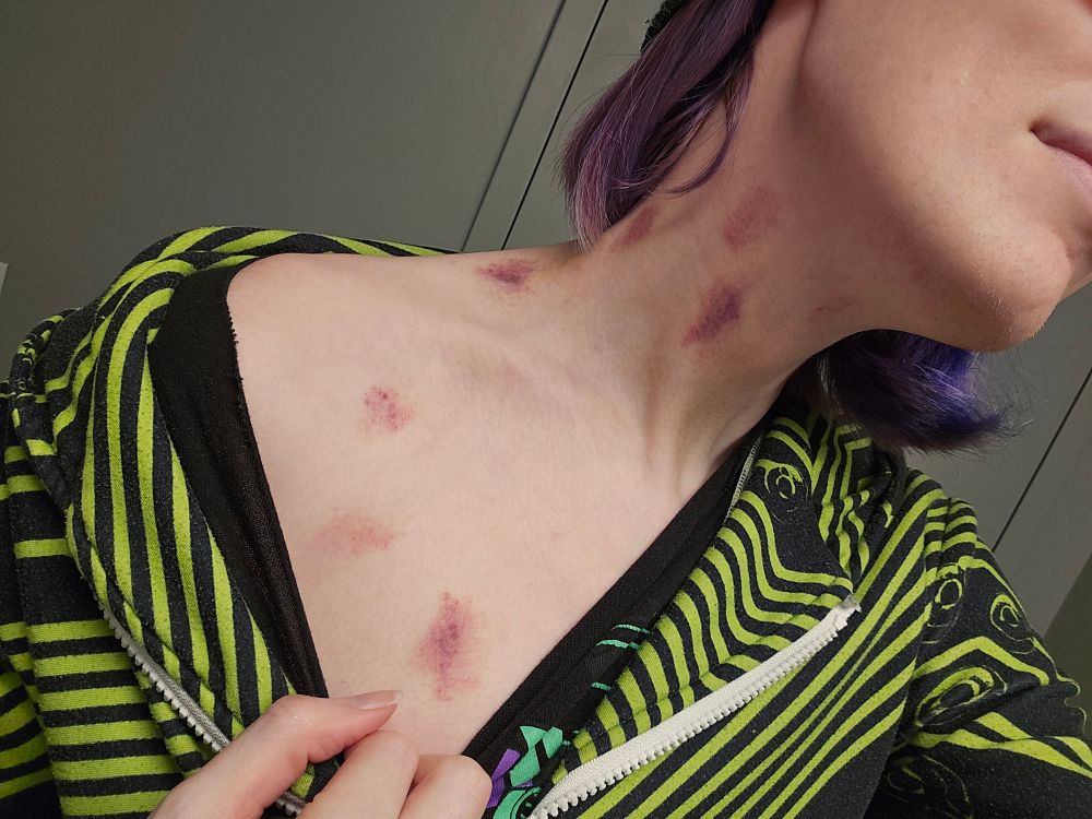 A photo of S13RRA's neck and upper chest, ze is pulling zir shirt down to reveal a series of dark hickies on zir neck and chest