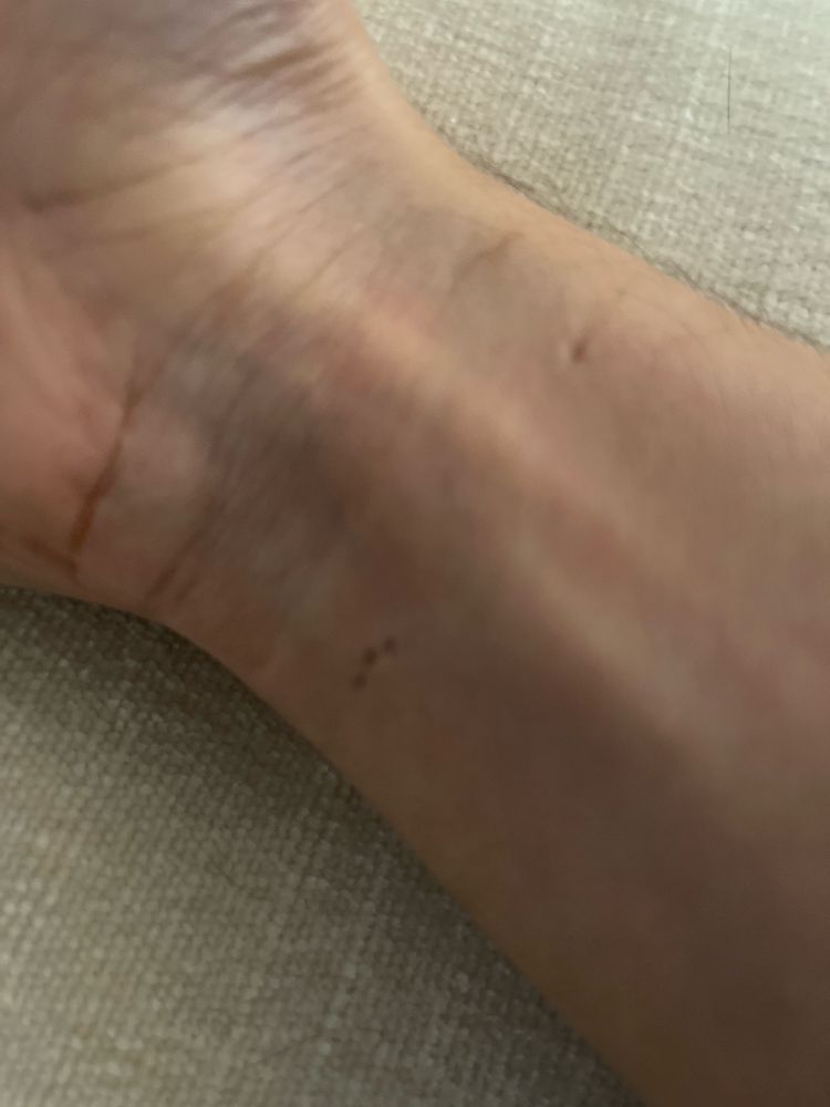 bitdizzy wrist covered in cat bite marks