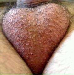 Close up of testicles that are tight against the bosy and resemble a heart in shape.
