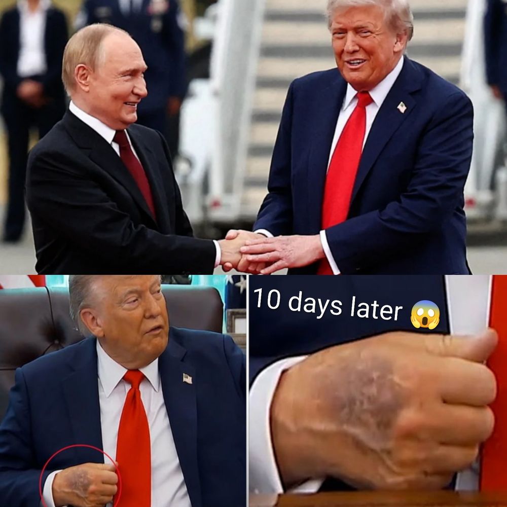 Photo of a jubilant glowing Vladimir Putin clasping hands with a slightly rueful Donald Trump at the red carpet Alaskan reception that Donald Trump gifted him just over 2 weeks ago Underneath it is a screenshot from an article about the White House saying that Trump's hands were badly bruised by too much handshaking, and aspirin and the words 