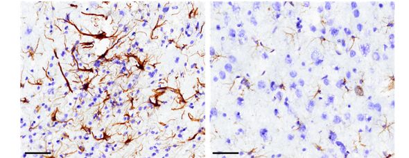 two immunohistochemistry images. the left has purple cells on a white background, small and mostly spherical in shape. on top of the purple cells are many long brown cells with lots of spidery processes. the right image has the purple cells but very few of the brown cells are visible. 