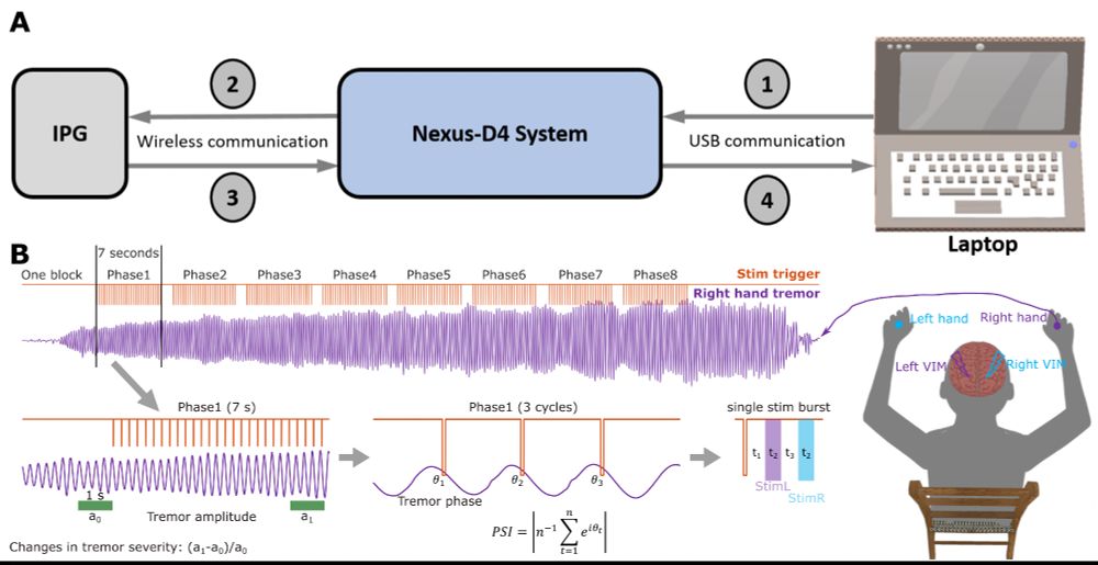 Protocol of tremor phase-locked deep brain stimulation (DBS) and its effect on tremor severity.