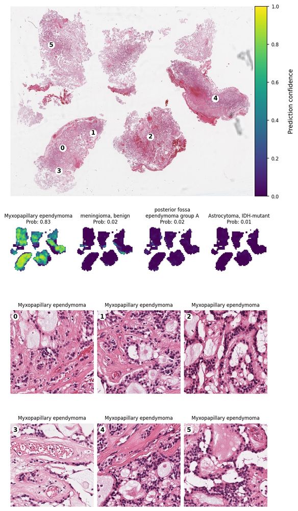 Example Paion report for a confirmed myxopapillary ependymoma diagnosis. Shown are H&E, prediction heatmaps and automatically selected representative image tiles. 