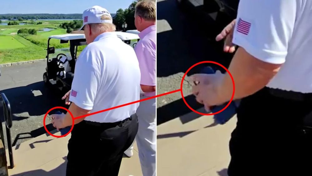 A new bruise has appeared on President Donald Trump’s left hand, adding to the one he’s had on his right hand for months, amid mounting questions about his health. The 79-year-old president hit the li...