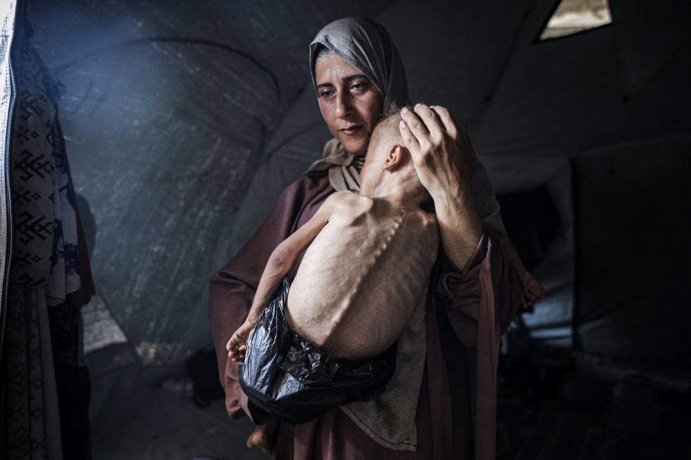 Uma mulher palestina, com expressão triste e serena, segura nos braços seu filho de 18 meses, Muhammad Zakariya Ayyoub al-Matouq, que está com grave quadro de desnutrição. O bebê aparece com o corpo extremamente magro, costelas e ossos da coluna totalmente à mostra, vestindo apenas uma fralda improvisada com saco plástico. A mãe o envolve com cuidado dentro de uma tenda escura, em um ambiente precário. A imagem escancara a crise humanitária extrema enfrentada pela população de Gaza. Crédito: Anadolu/Getty Images.