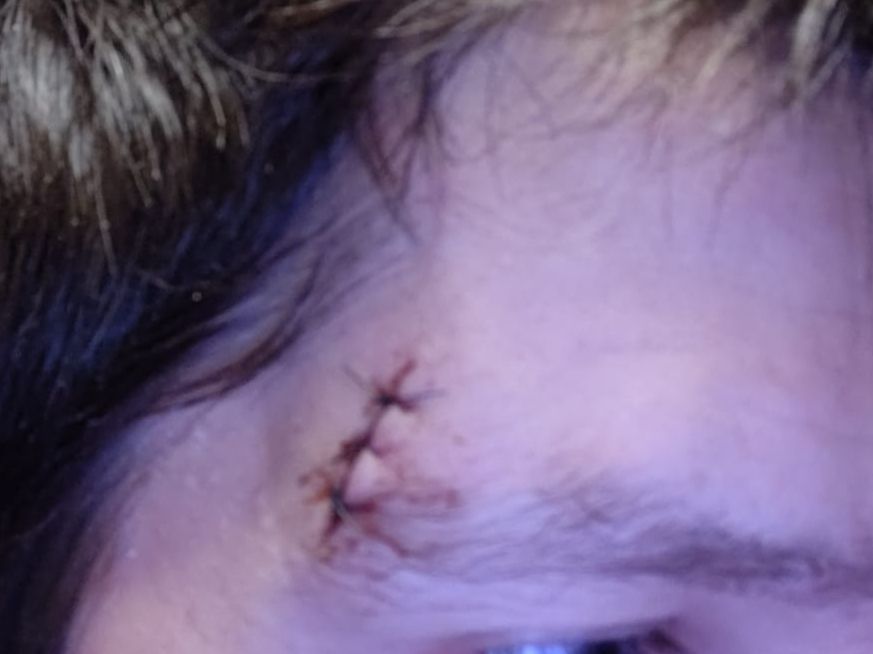 Foto van hechtingen boven het oog