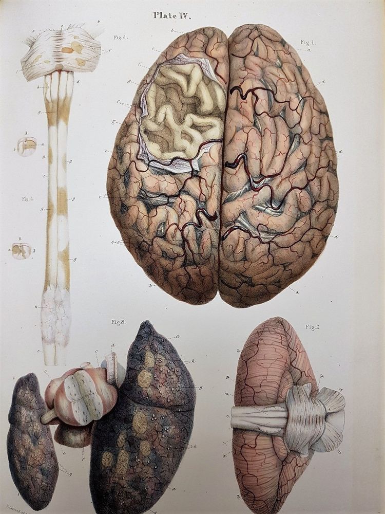 Hand coloured lithograph which includes illustrations depicting cerebral atrophy and medulla spinalis with sclerotic parts. Robert Carswell, a pathologist, was commissioned by military surgeon and RCSEd President John Thompson to produce a collection of drawings illustrating morbid anatomy.   