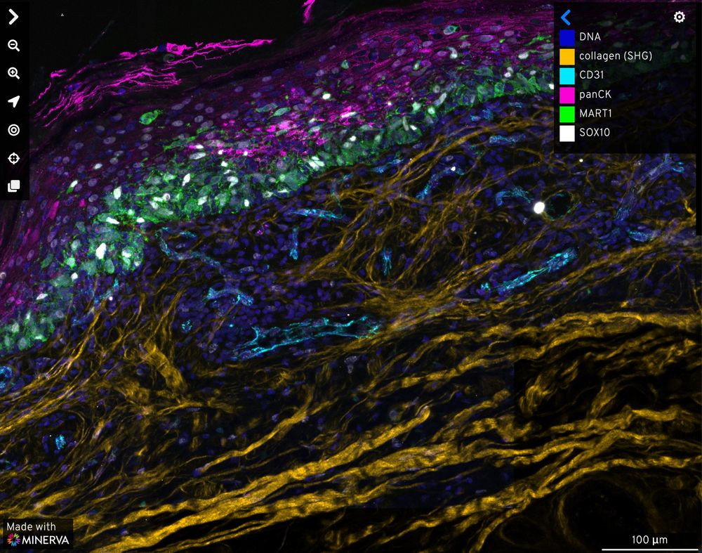 Long orange collagen fibrils at bottom of image. Blue ovals (nuclei) throughout image. Middle layer of tumor cells with green scale-like appearance (MART1) and white ovals (SOX10). Top layer of magenta scales and fibrils (pan-cytokeratin). Scale bar is 100 microns.