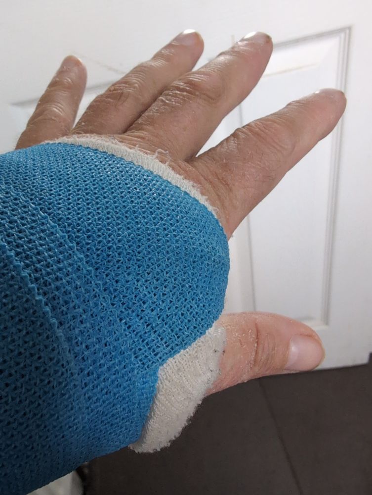 Hand with arm in blue cast 