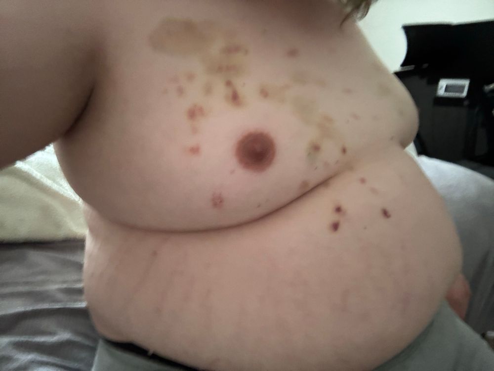 pic of chubby trans woman on her side with bite marks and very apparent bruises shown