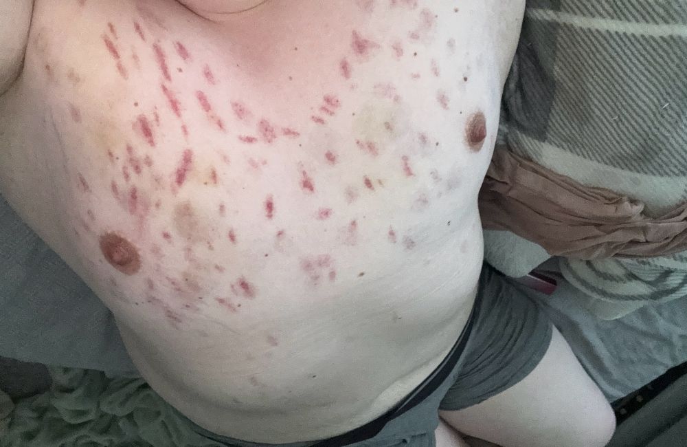 pics of a trans girls tits with bite marks all over them, up to a ring above the collarbone