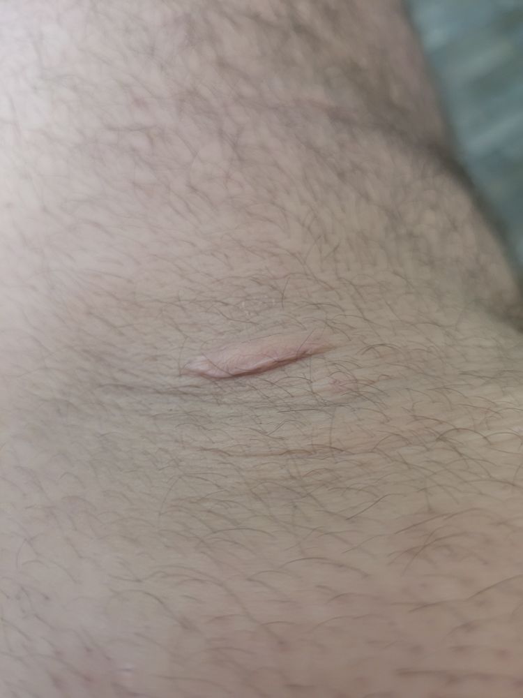 knee scar, outfolded