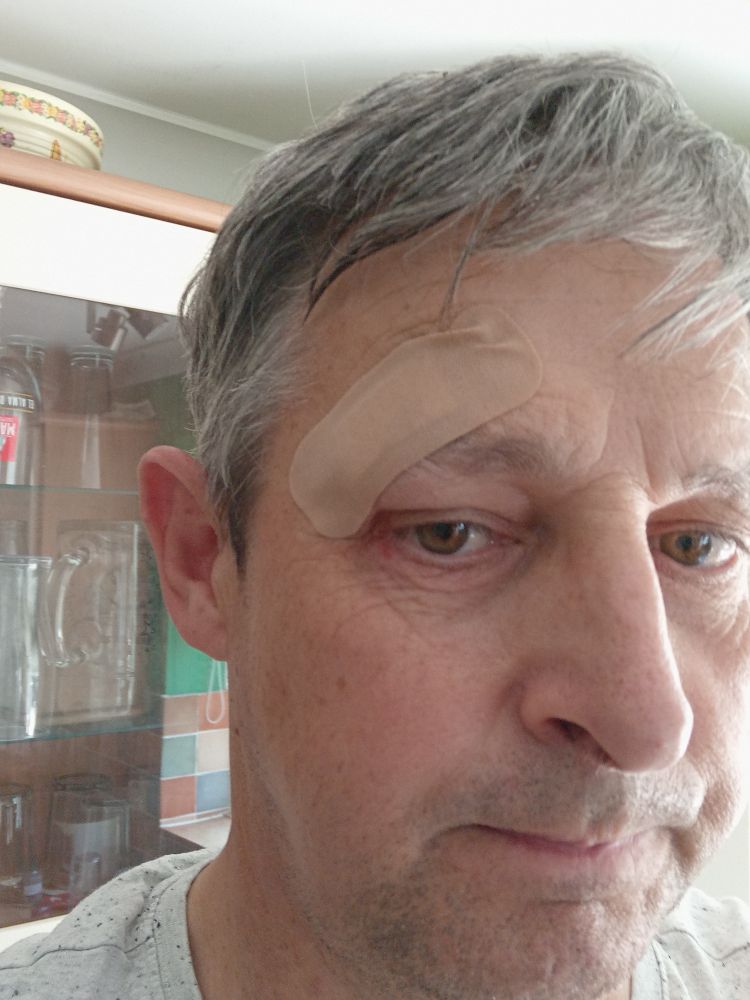 A selfie of an idiot with a plaster over one eye, which he hopes will staunch the fliw of blood. 