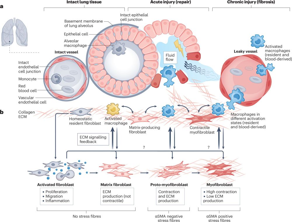 Lung fibrosis