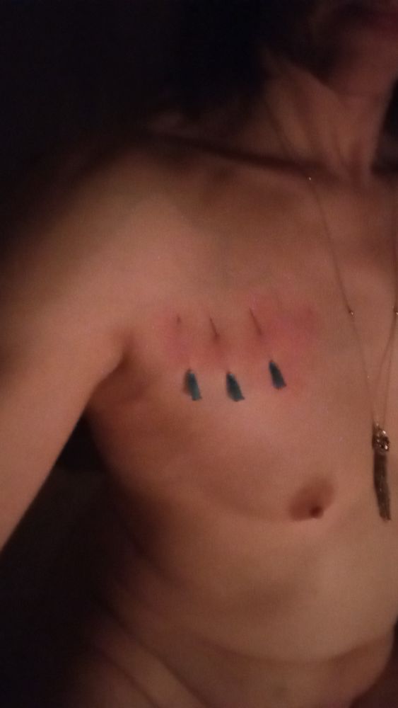 In this shot, you can see my chin in three-quarters profile, a hintof my lips, the sharp lines of my neck muscles and collar bones, three needles inserted vertically above my small breast, a bit of my arm and shoulder, and the curve of my stomach toward my navel where the flesh rolls a little, suggesting a softness there. The needles have been inserted upward, the blue base below and the sharp tip above, and the skin is red where I have patted the needles firmly with my fingers. My silver pendant can be seen at the edge of the shot.