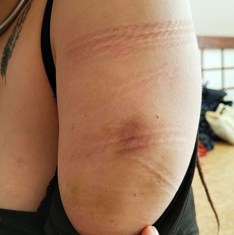 Arm mit blauen Flecken und Seilspuren 