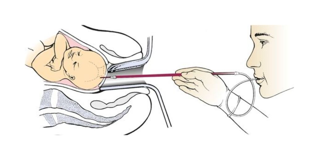 Bild einer Mikroblutuntersuchung: dem Kind im Geburtskanal ist eine Glasröhre auf den Kopf gesetzt. Die untersuchende Person saugt (!) Blut in die dünne Röhe