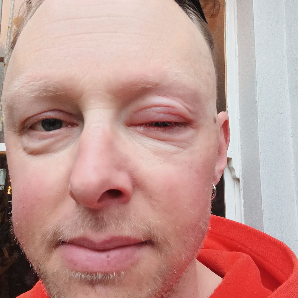 a shot of my face showing my puffy eyelid after my injection yesterday