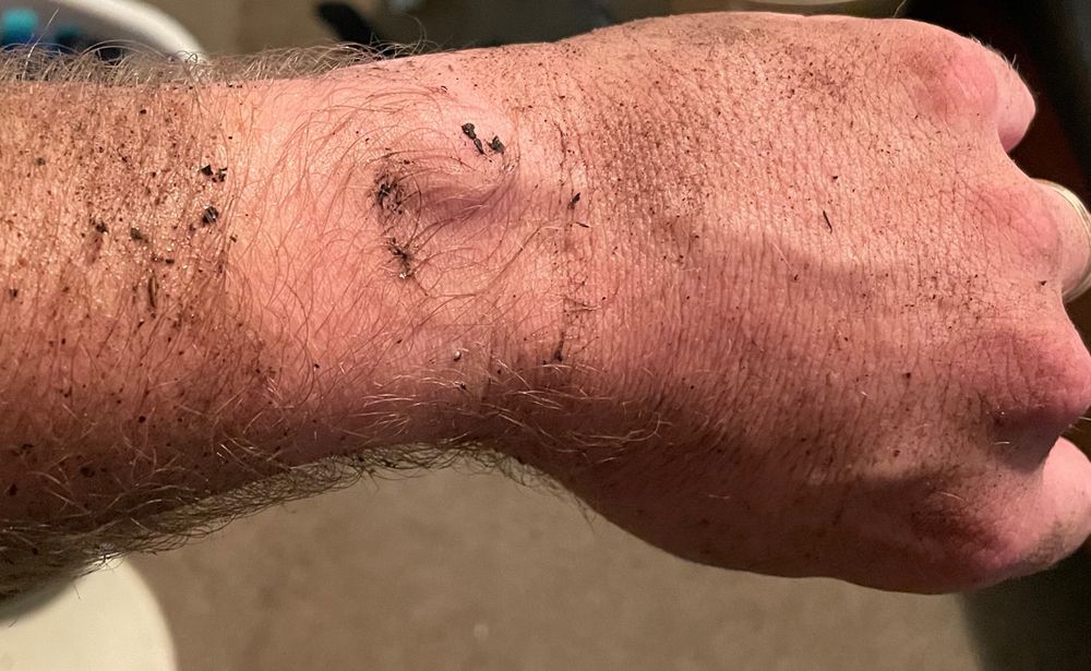 Photo of a filthy wrist with a clean-ish spot where a watch had been. 