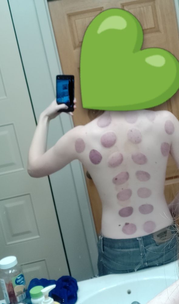Selfie with the face covered by an emoji. Deep purple circular bruises cover my back.