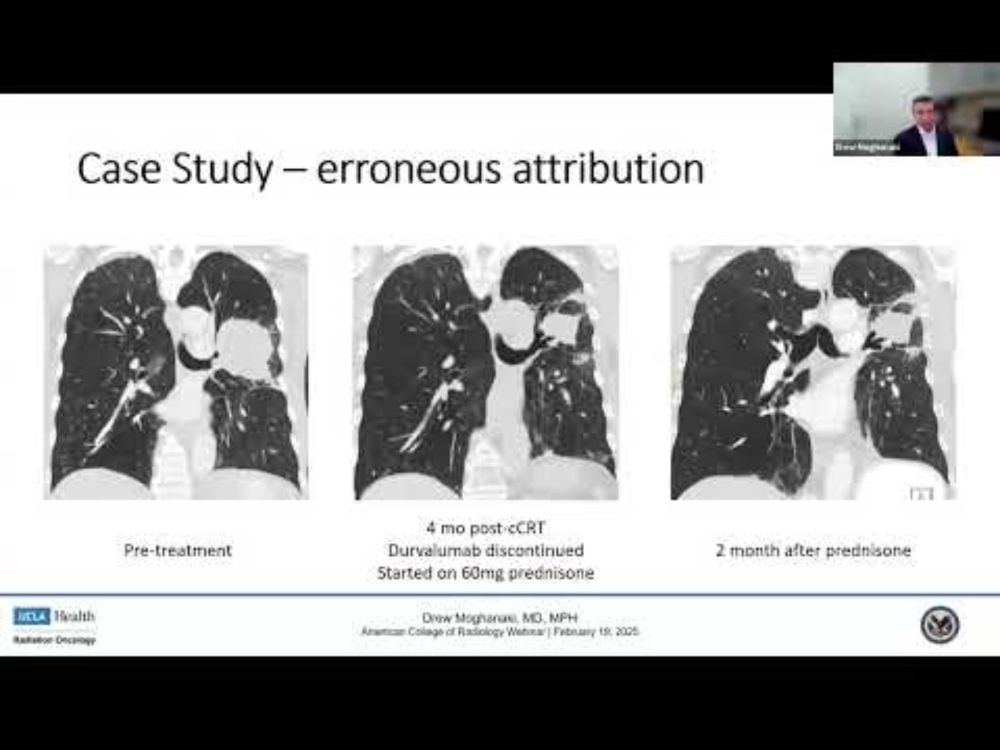 Distinguishing Immune Related vs  Radiation Pneumonitis following Thoracic Radiotherapy