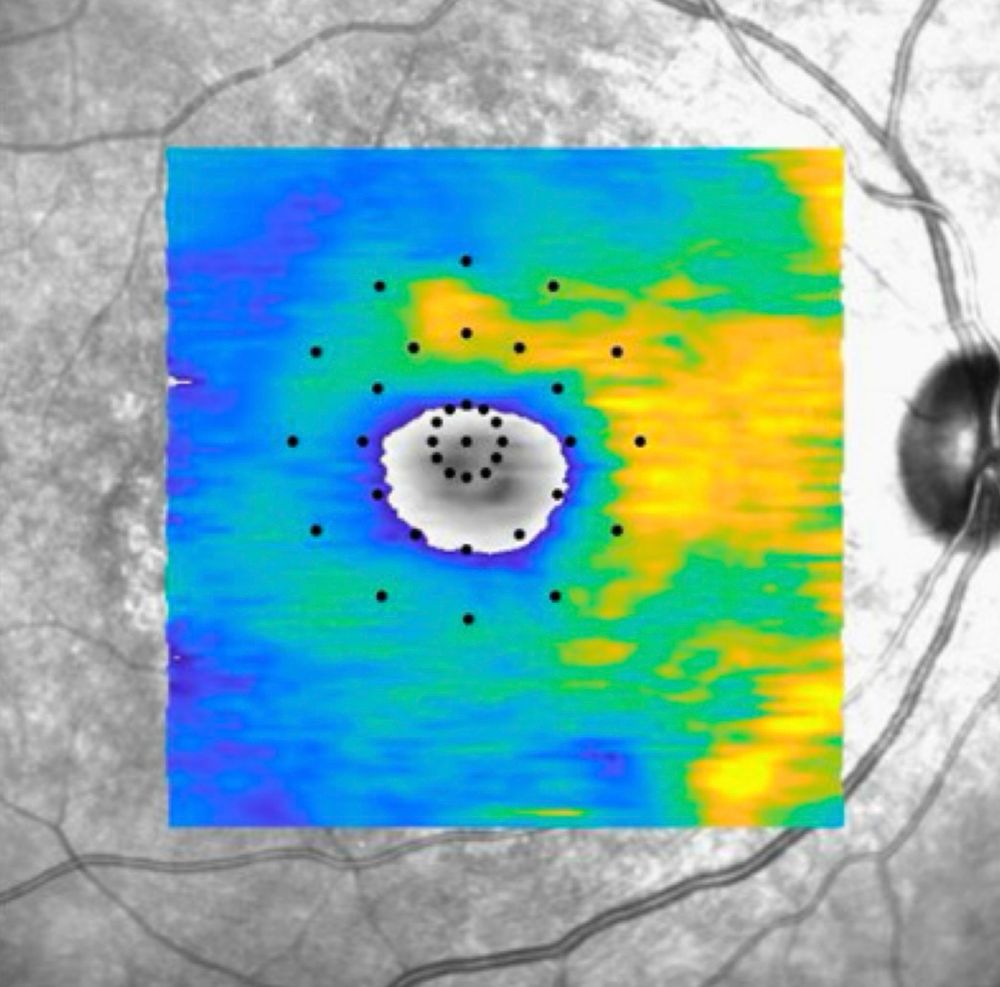 Eccentric fixation when microperimetry grid data is overlayed on top of en face SD-OCT. 