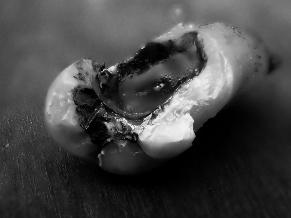Ein gezogener Zahn mit einer großen Höhle,  Teile davon sind abgebrochen 