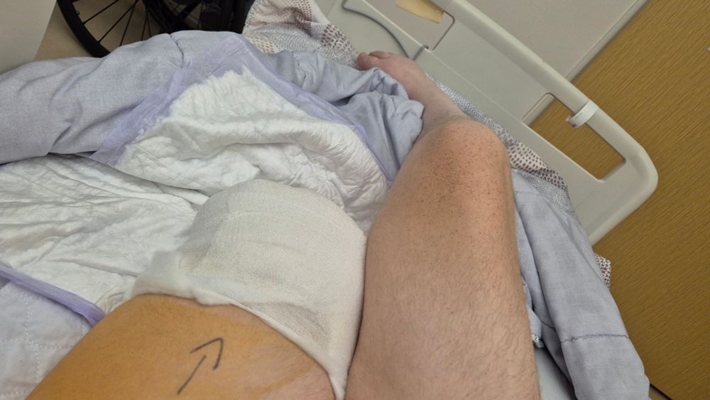 Foto van een pas geamputeerde linker bovenbeenstomp met verband eromheen. Op de stomp is een pijl getekend, zodat de chirurg zich niet kon vergissen wel been geamputeerd moest worden. De voet van het blote rechterbeen ligt in een spitsstand. De persoon ligt in een ziekenhuisbed.