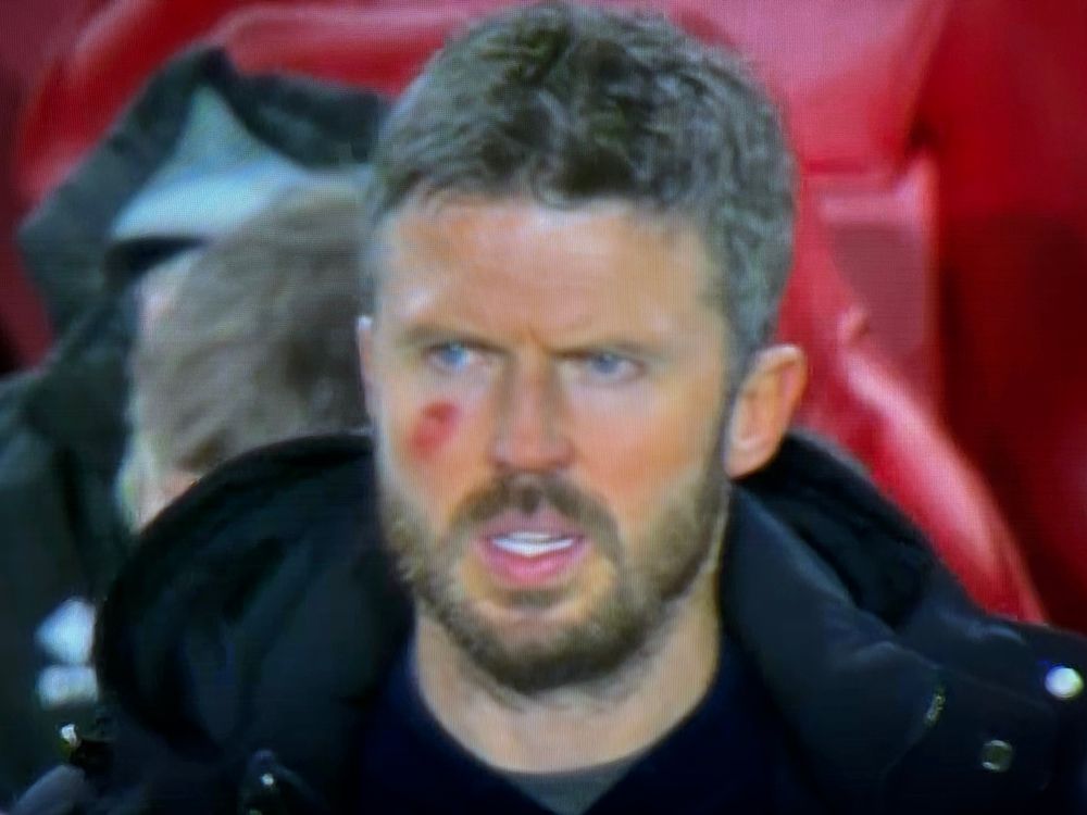 A picture of Michael Carrick in today’s Boro vs Burnley match with marks on his face, much like was seen on Pep Guardiola’s face a few weeks ago
