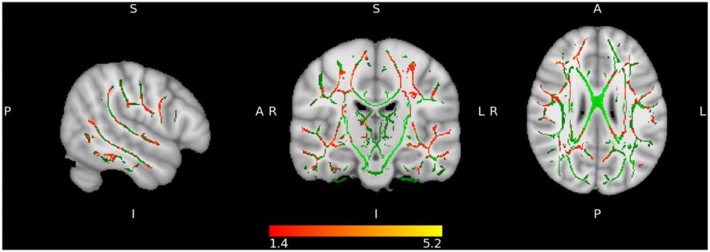 Frontiers | Multimodal neuroimaging in Long-COVID and its correlates with cognition 1.8 years after SARS-CoV-2 infection: a cross-sectional study of the Aliança ProHEpiC-19 Cognitiu