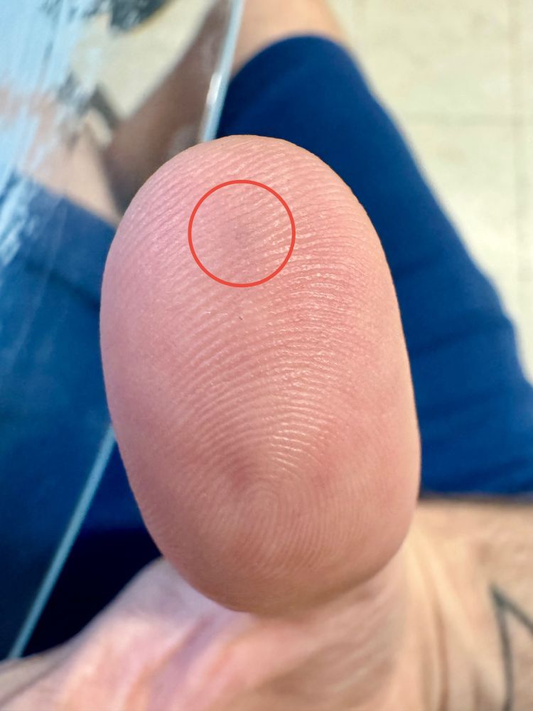 OldManGrim’s thumb, red circle indicating area of lead poisoning