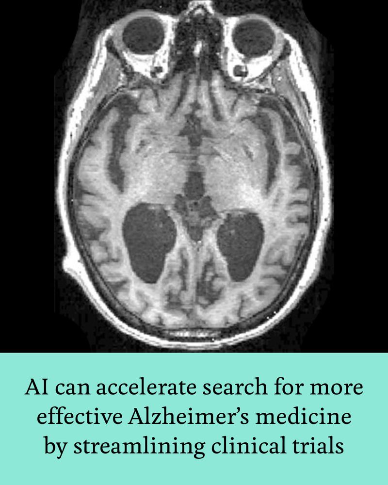 MRI brain scan of a patient progressing rapidly to Alzheimer’s disease.