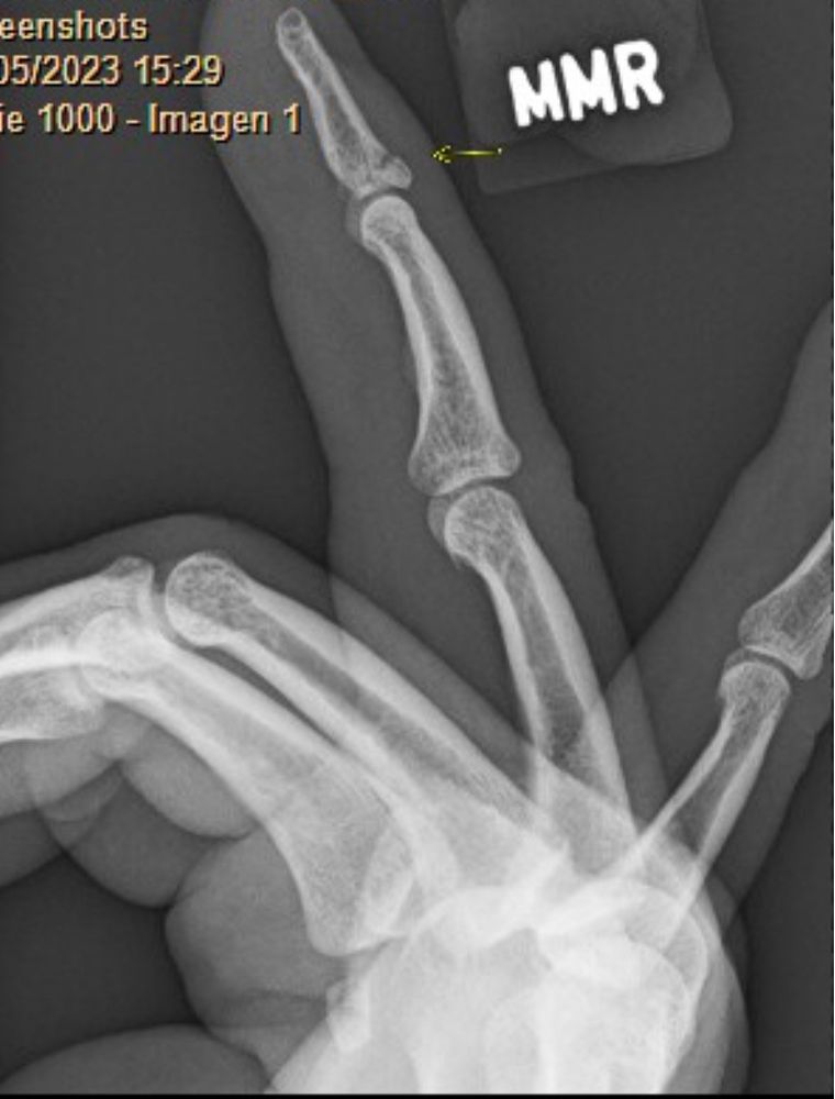 x-ray with fracture on right ring finger