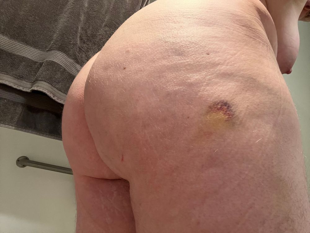 butt with a cute little bruise