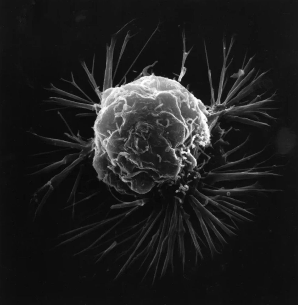 electron microscopy image of a breast cancer cell