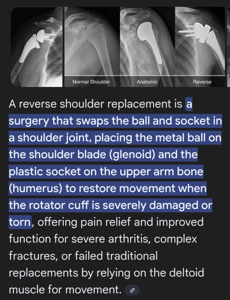 A screenshot explaining about a reverse shoulder replacement surgery from Google