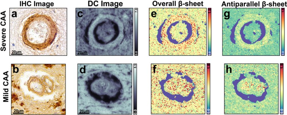 Lipid mediated formation of antiparallel aggregates in cerebral amyloid angiopathy - Acta Neuropathologica