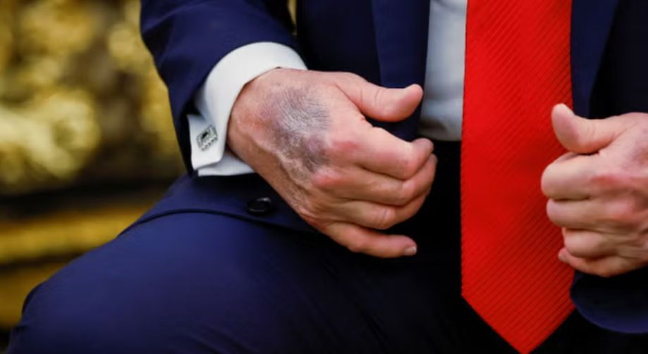 president trump and his rotting right hand