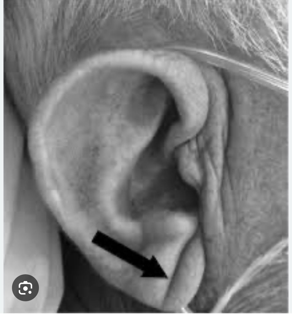 Ligne sur le lobe d’oreille d’une personne 