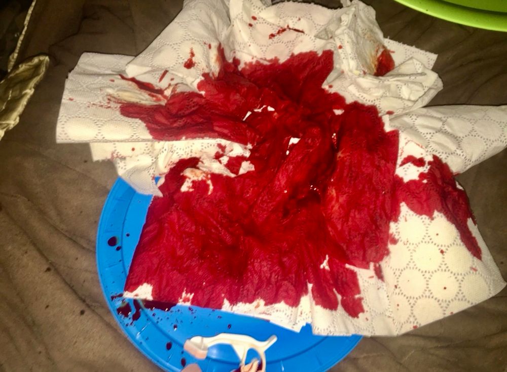 Tissues soaked in blood with a nasal rhino clip at the bottom of the photo. 