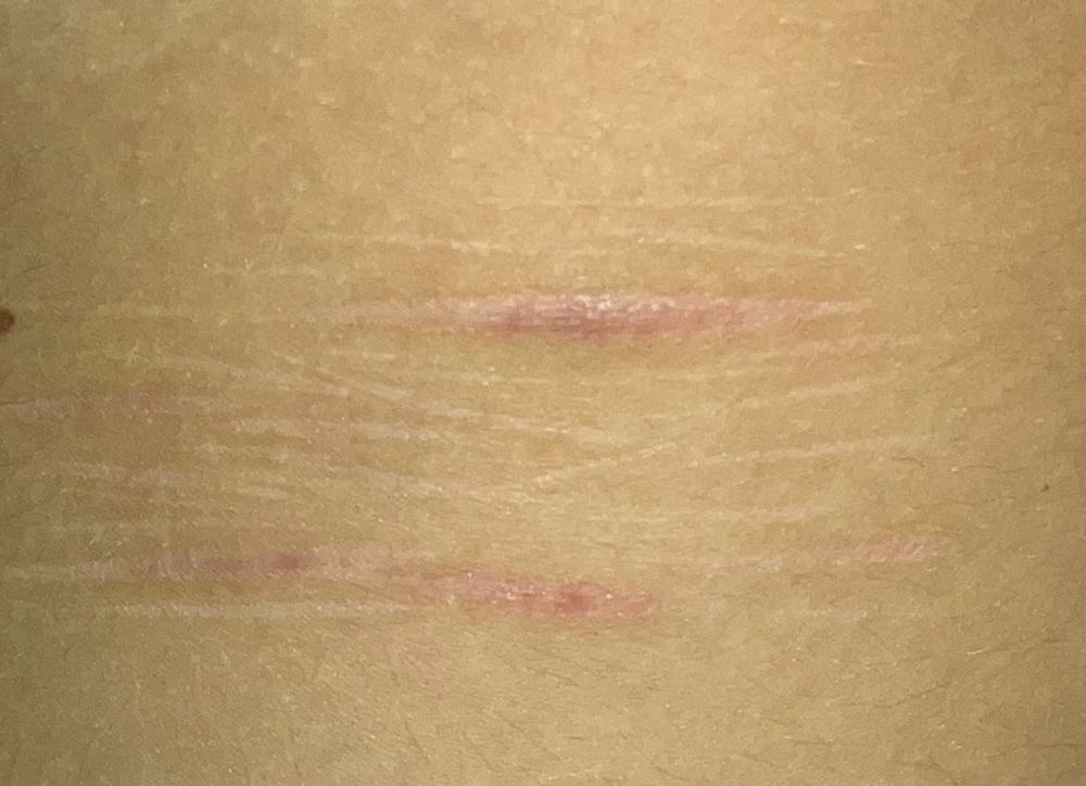 Scars.