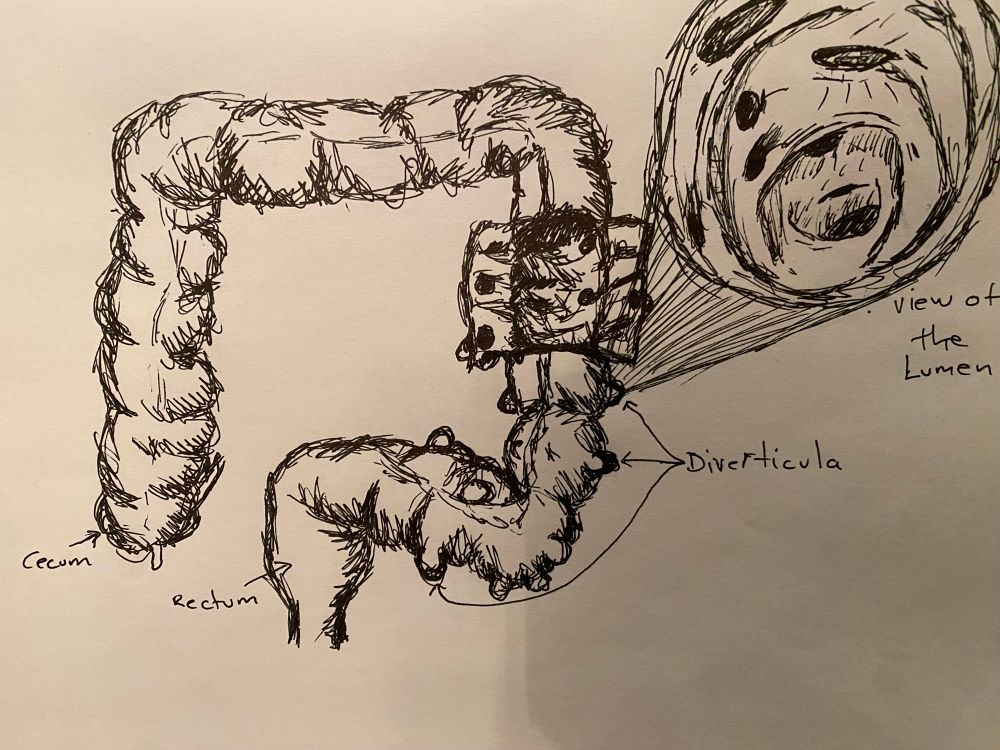 Drawing by Kaveh of a colon with diverticula on the left side 