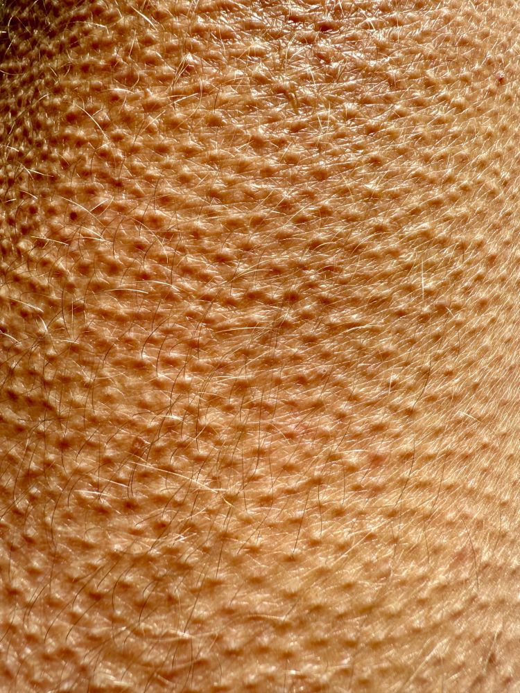 ChatGPT: Makroaufnahme menschlicher Haut mit deutlich sichtbaren Poren, feinen Haaren und ausgeprägter Gänsehaut.