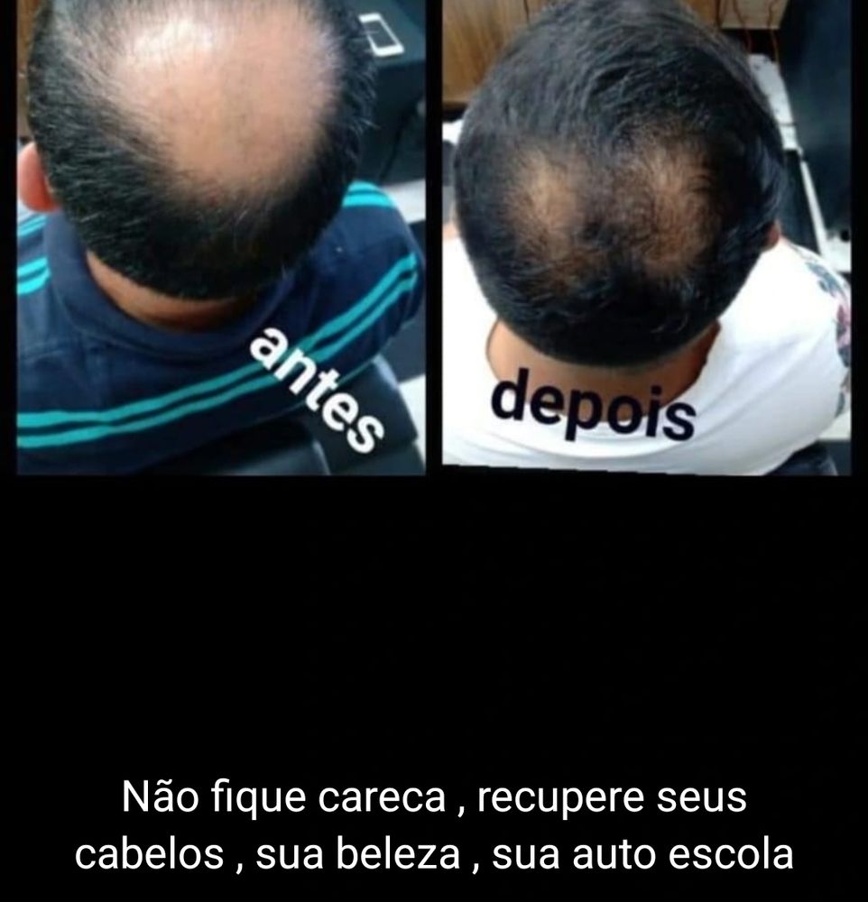 Print de um status do whatsapp, no print tem duas fotos, antes e depois, vista de cima, evidenciando a calvície dele, na foto do antes a esquerda ele está muito calvo, na do depois à direita, ele continua calvo mas agora ele engana melhor. Na parte de baixo do print tem uma legenda dizendo: não fique careca, recupere seus cabelos, sua beleza, sua auto escola.
