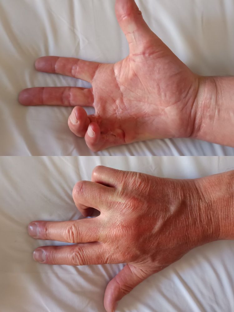 Twee foto's van mijn rechterhand, een van de rug en een van de palm, bij de met gespreide vingers. Waarbij goed te zien is hoe 'gebogen' mijn pink en ringvinger staan. Om en nabij 90°.