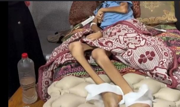 Image of a starved childs wasted legs