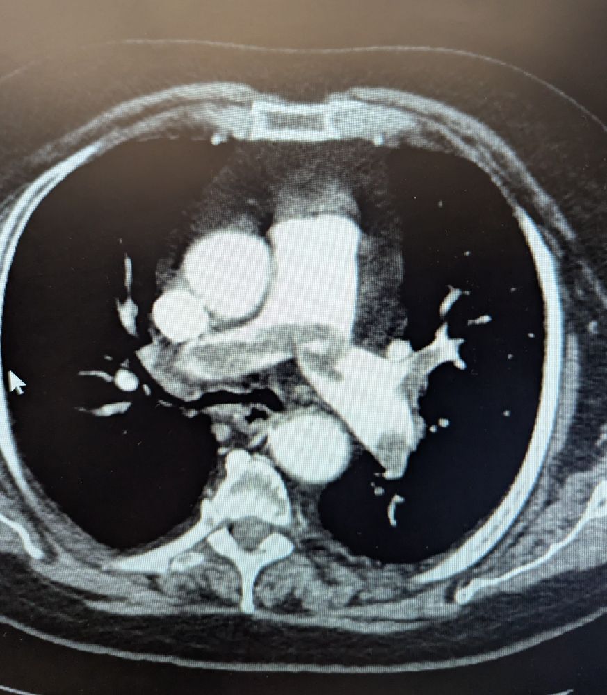Cat scan of the chest showing a saddle embolism going into both pulmonary arteries 