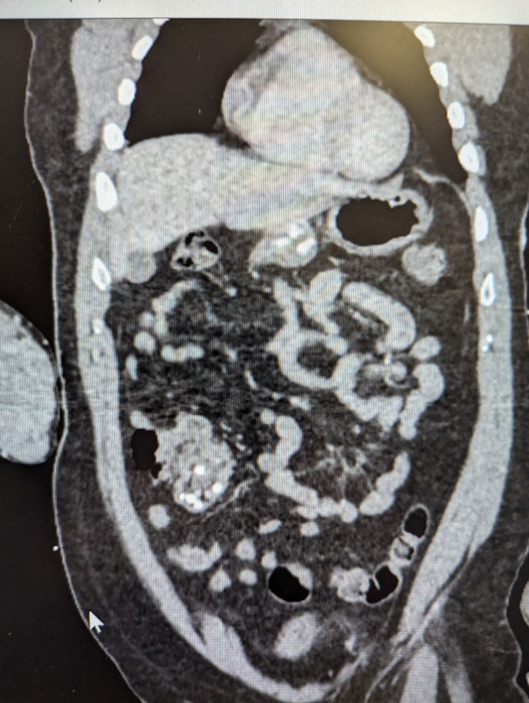 Ingested foreign bodies