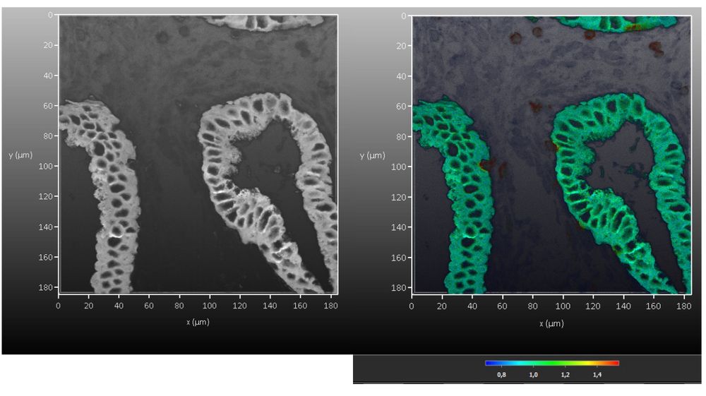 Cervical cancer tissue stained with PanCK-Opal 780 - Imaged on a Leica STELLARIS FALCON